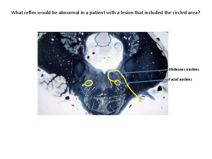 What reflex would be abnormal in a patient with a lesion that included the