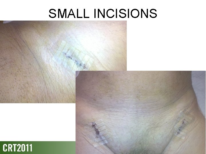 SMALL INCISIONS 
