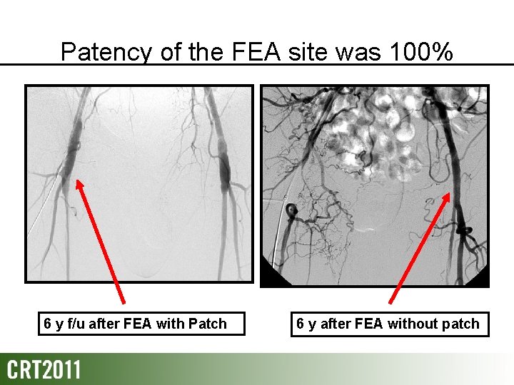 Patency of the FEA site was 100% 6 y f/u after FEA with Patch