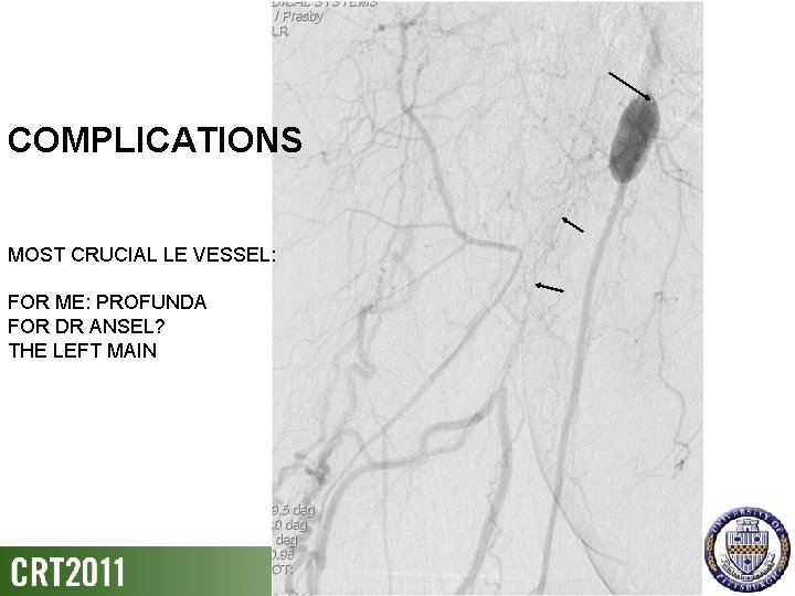 COMPLICATIONS MOST CRUCIAL LE VESSEL: FOR ME: PROFUNDA FOR DR ANSEL? THE LEFT MAIN
