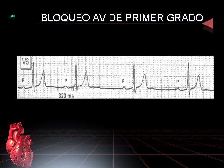 BLOQUEO AV DE PRIMER GRADO 