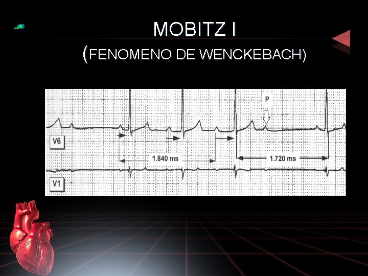 MOBITZ I (FENOMENO DE WENCKEBACH) 
