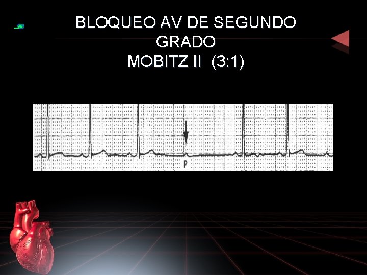 BLOQUEO AV DE SEGUNDO GRADO MOBITZ II (3: 1) 