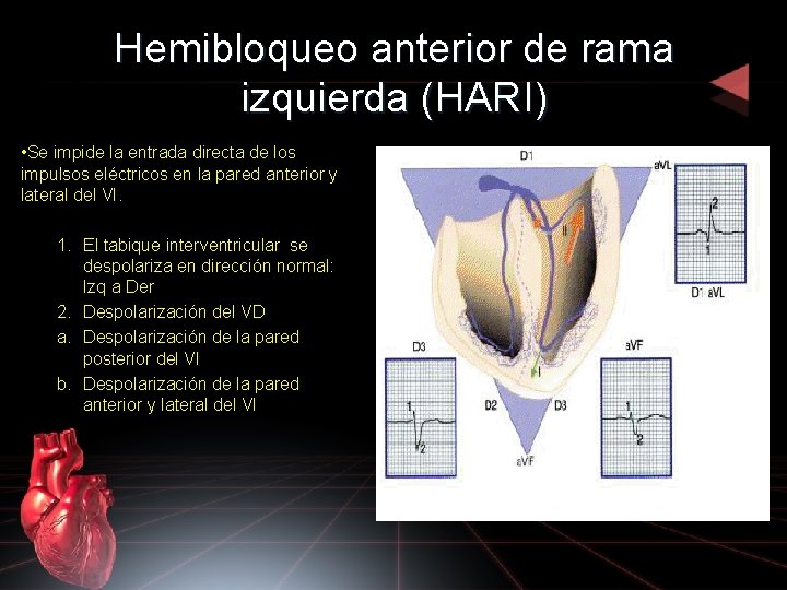 Hemibloqueo anterior de rama izquierda (HARI) • Se impide la entrada directa de los