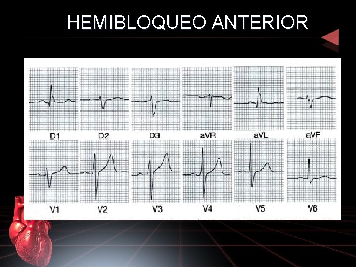 HEMIBLOQUEO ANTERIOR 