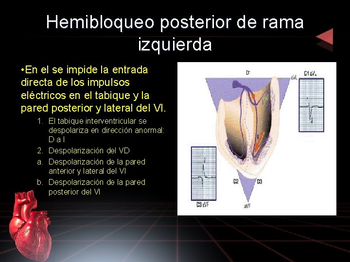 Hemibloqueo posterior de rama izquierda • En el se impide la entrada directa de