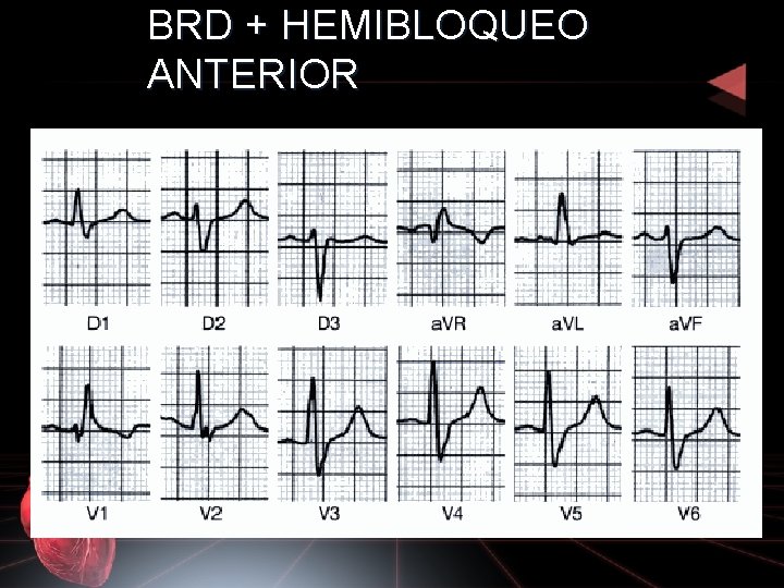 BRD + HEMIBLOQUEO ANTERIOR 