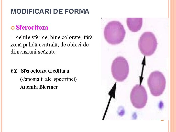 MODIFICARI DE FORMA Sferocitoza = celule sferice, bine colorate, fără zonă palidă centrală, de