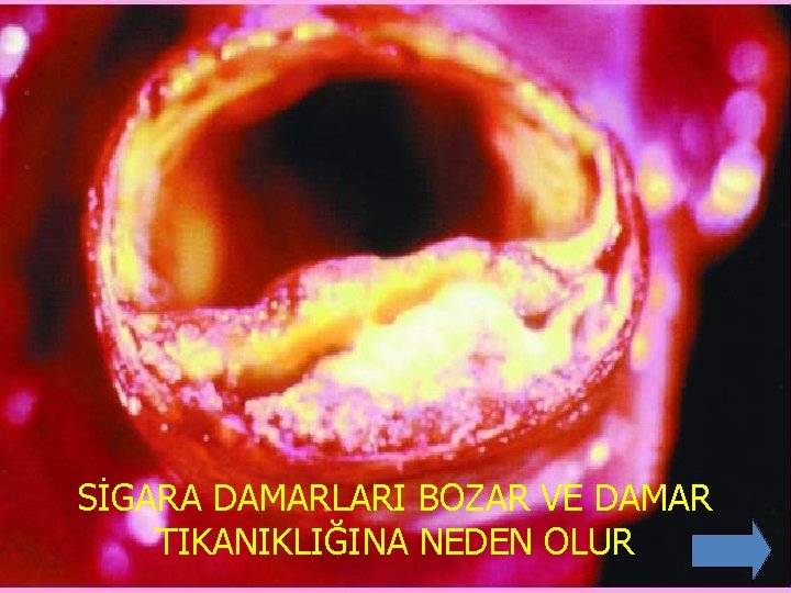 SİGARA DAMARLARI BOZAR VE DAMAR TIKANIKLIĞINA NEDEN OLUR 