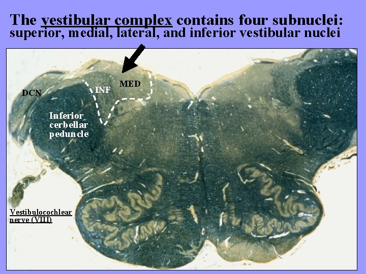 The vestibular complex contains four subnuclei: superior, medial, lateral, and inferior vestibular nuclei INF
