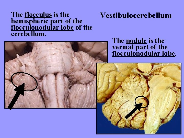 The flocculus is the hemispheric part of the flocculonodular lobe of the cerebellum. Vestibulocerebellum