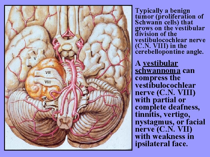 Typically a benign tumor (proliferation of Schwann cells) that grows on the vestibular division