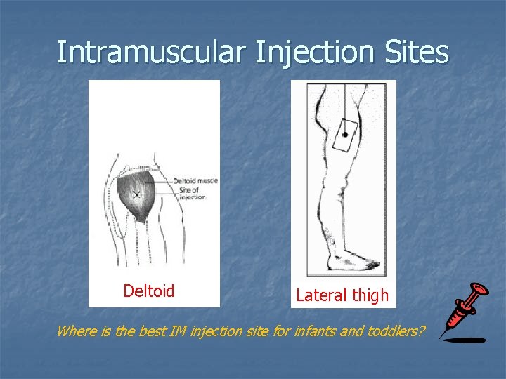 Intramuscular Injection Sites Deltoid Lateral thigh Where is the best IM injection site for