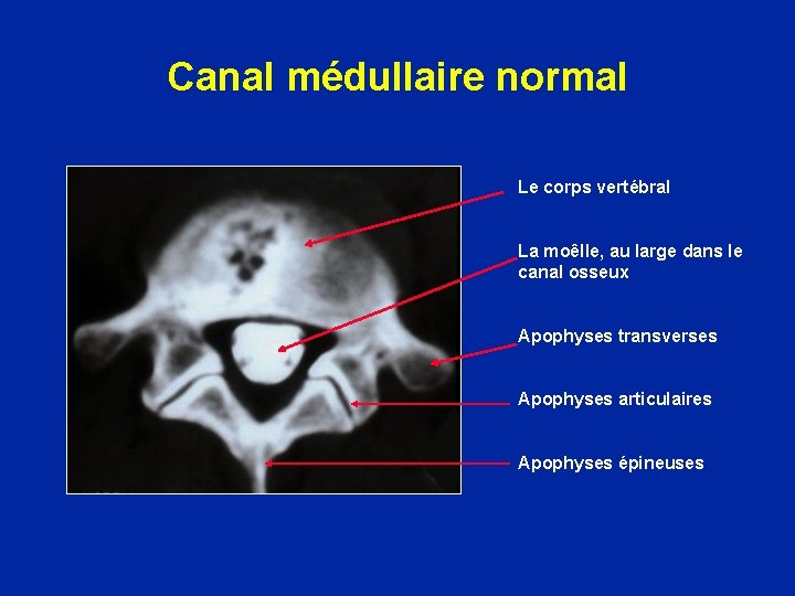 Canal médullaire normal Le corps vertébral La moêlle, au large dans le canal osseux