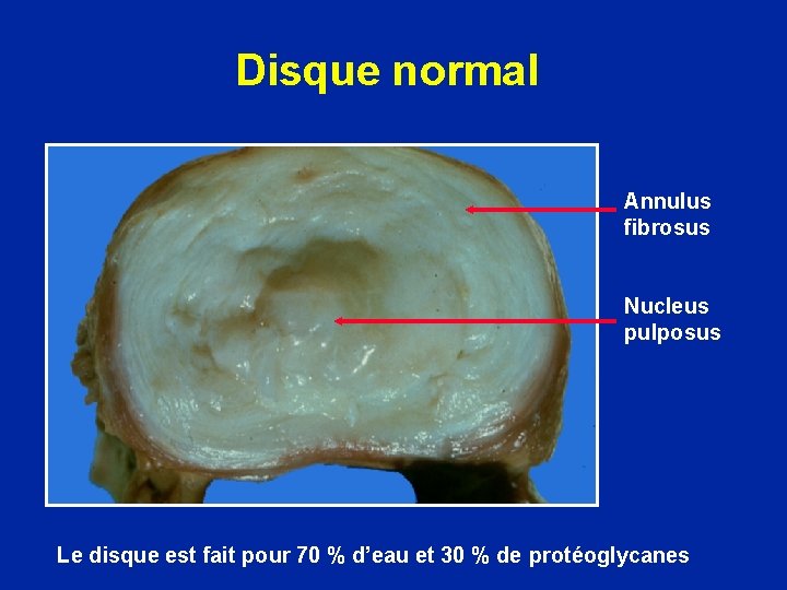 Disque normal Annulus fibrosus Nucleus pulposus Le disque est fait pour 70 % d’eau