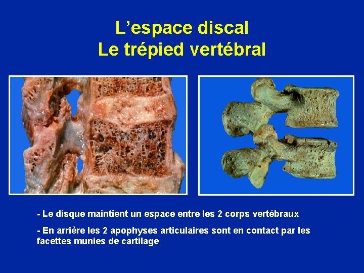 L’espace discal Le trépied vertébral - Le disque maintient un espace entre les 2