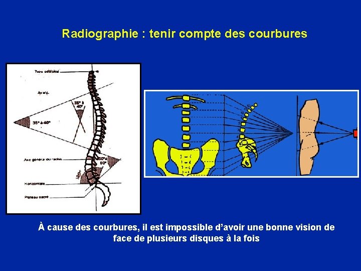 Radiographie : tenir compte des courbures À cause des courbures, il est impossible d’avoir