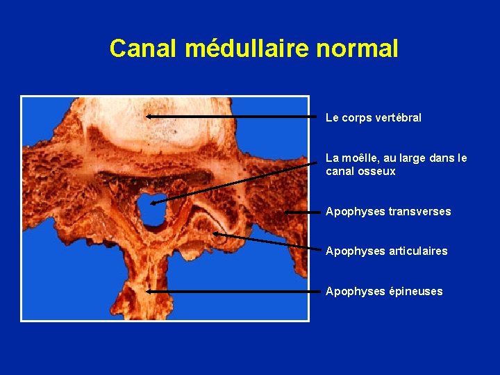 Canal médullaire normal Le corps vertébral La moêlle, au large dans le canal osseux