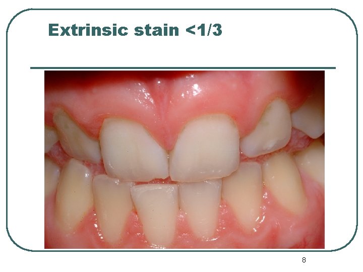 Extrinsic stain <1/3 8 