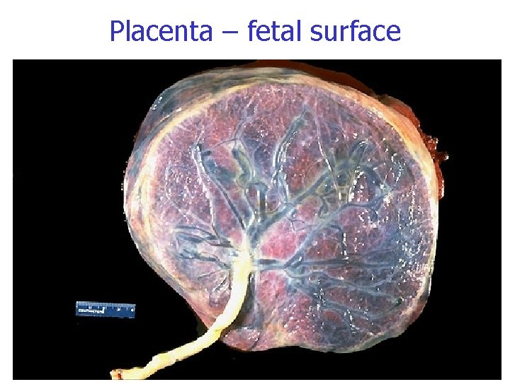 Placenta – fetal surface 