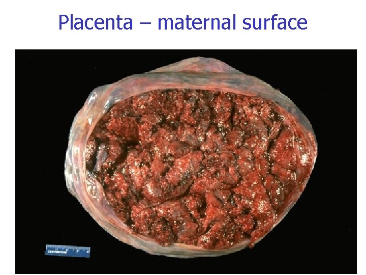 Placenta – maternal surface 