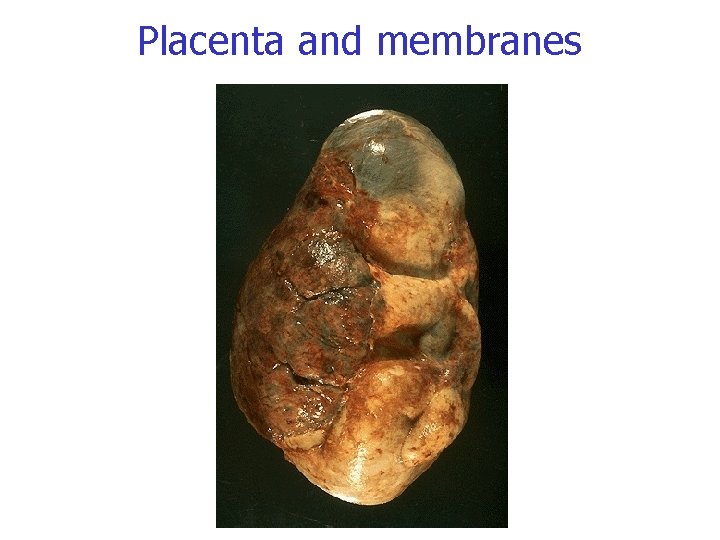 Placenta and membranes 