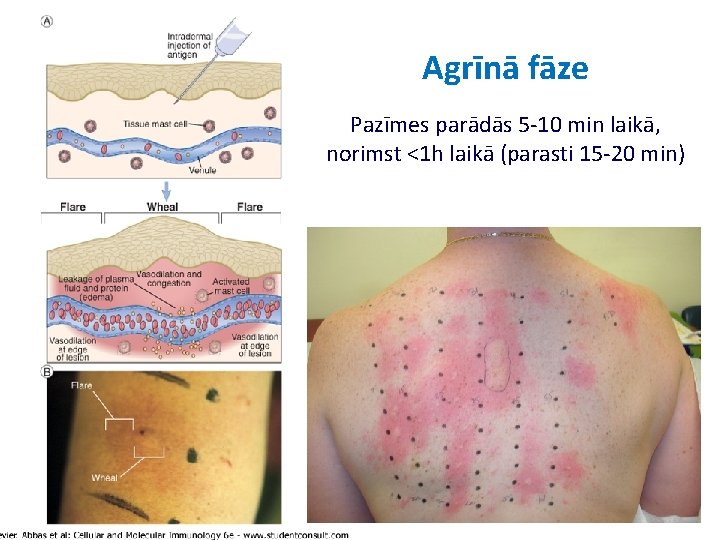 Agrīnā fāze Pazīmes parādās 5 -10 min laikā, norimst <1 h laikā (parasti 15