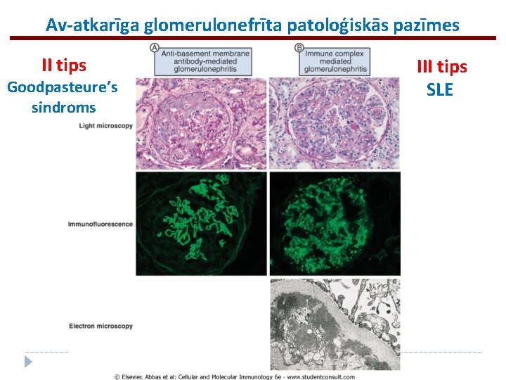 Av-atkarīga glomerulonefrīta patoloģiskās pazīmes II tips Goodpasteure’s sindroms III tips SLE 