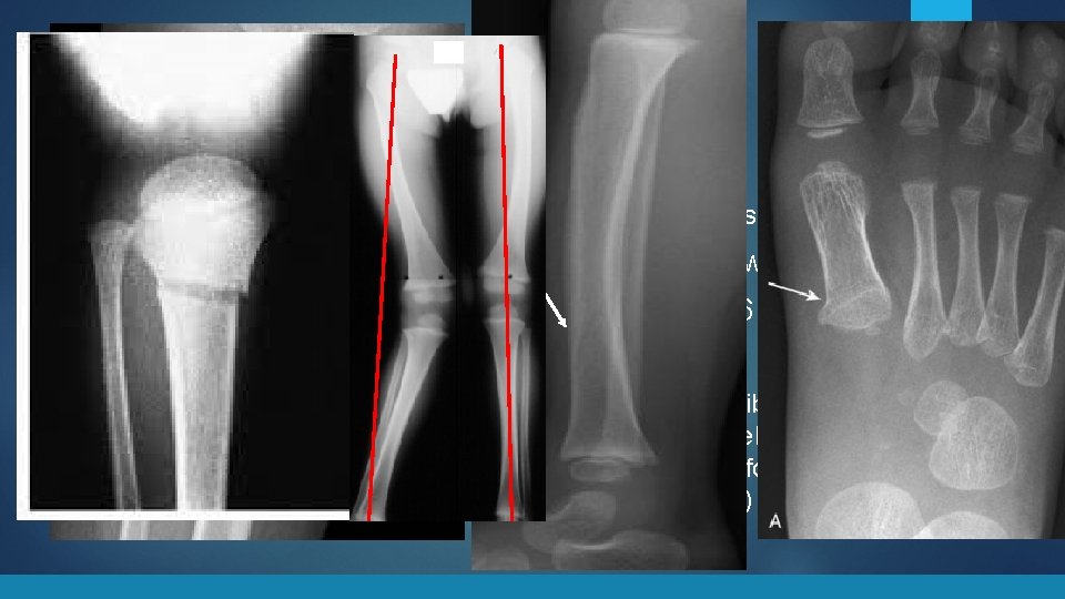 Toddler’s Fractures Tests § Xray: nondisplaced subtle fracture Treatment § Self limiting § Sometimes