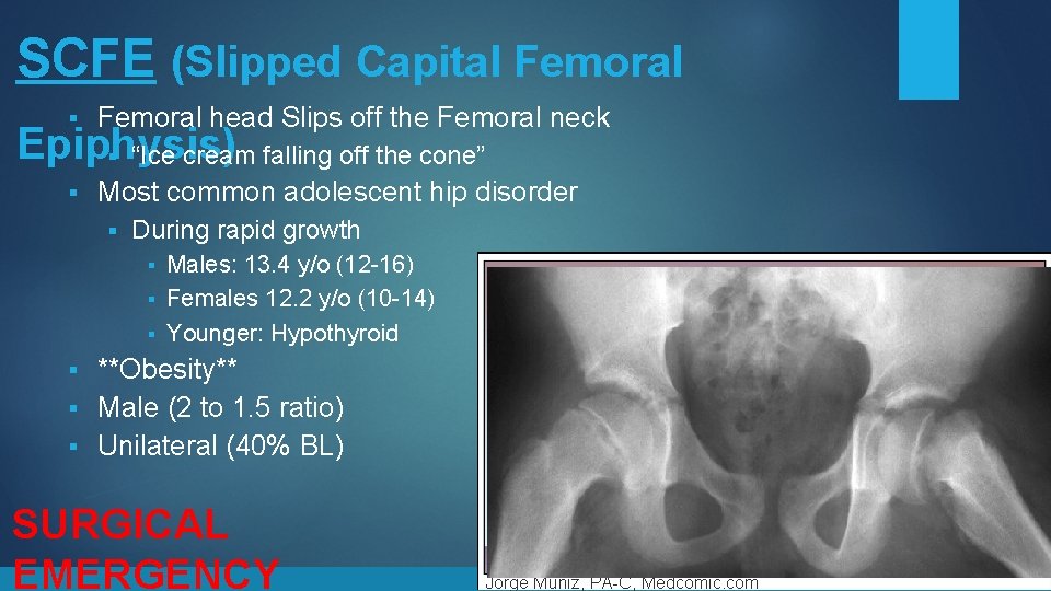 SCFE (Slipped Capital Femoral § Femoral head Slips off the Femoral neck § Most