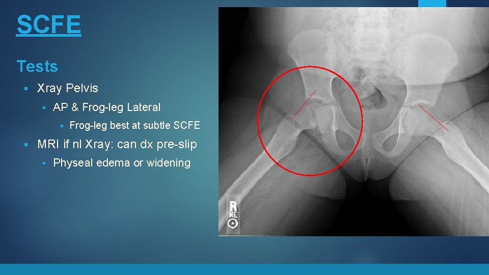SCFE Tests § Treatment Xray Pelvis § AP & Frog-leg Lateral § § Frog-leg