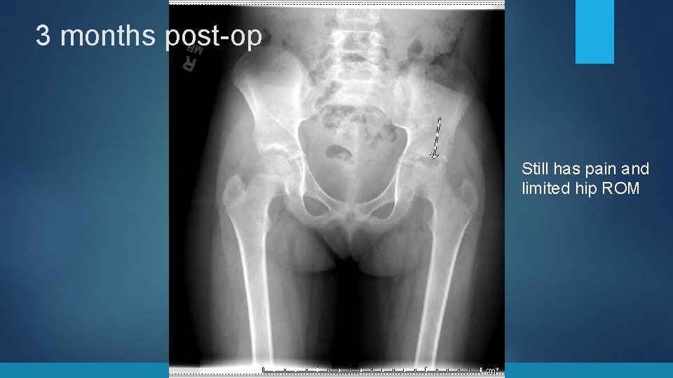 3 months post-op Still has pain and limited hip ROM 