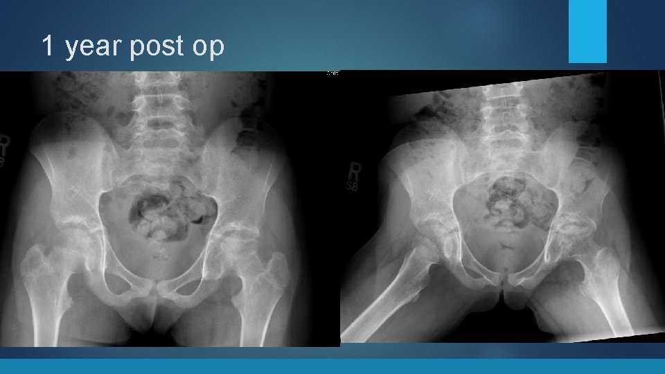 1 year post op 