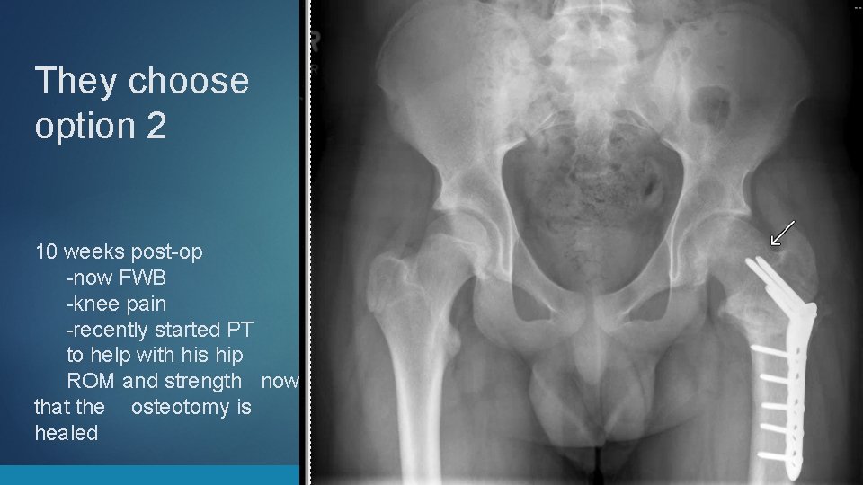 They choose option 2 10 weeks post-op -now FWB -knee pain -recently started PT