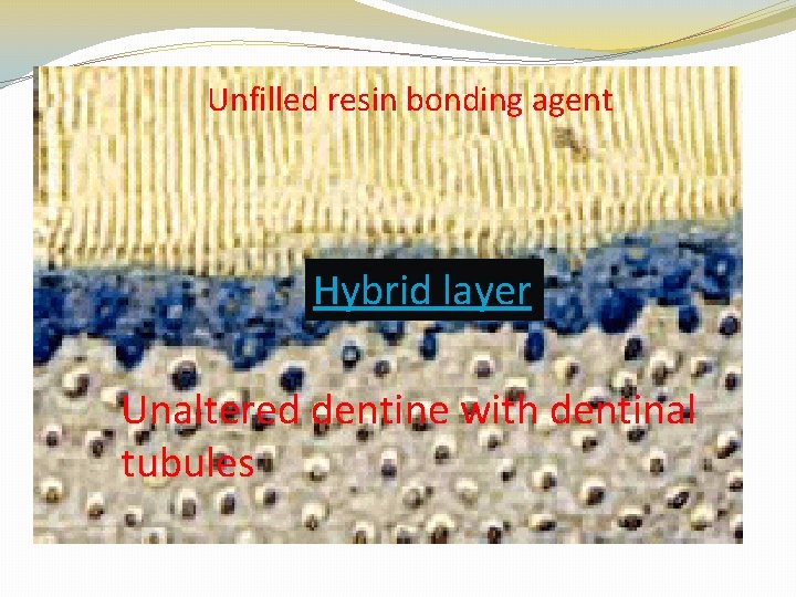 Unfilled resin bonding agent Hybrid layer Unaltered dentine with dentinal tubules 