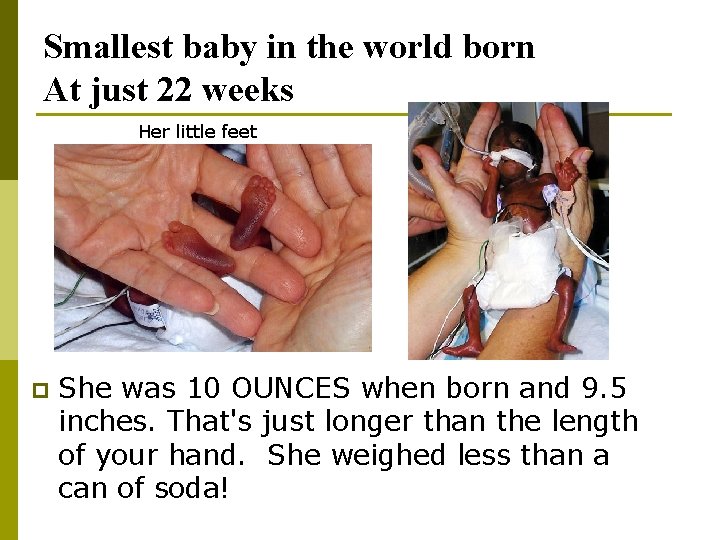 Smallest baby in the world born At just 22 weeks Her little feet p