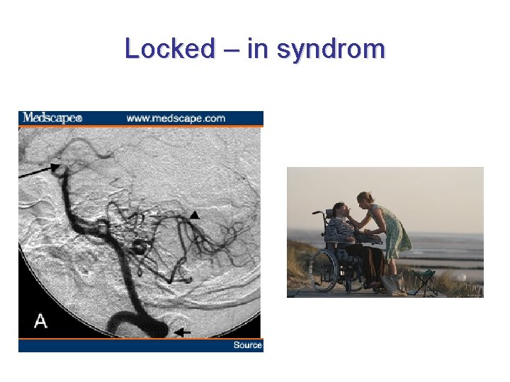 Locked – in syndrom 