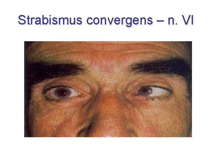 Strabismus convergens – n. VI 