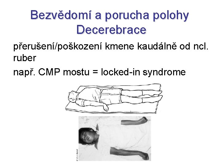 Bezvědomí a porucha polohy Decerebrace přerušení/poškození kmene kaudálně od ncl. ruber např. CMP mostu