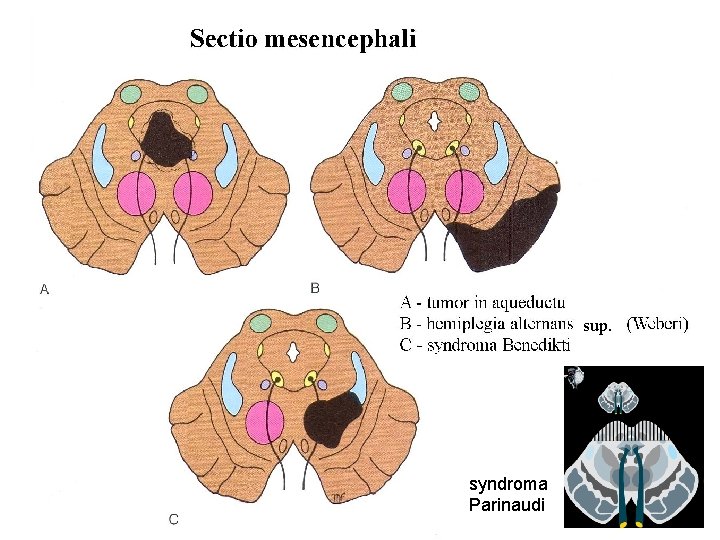 sup. syndroma Parinaudi 