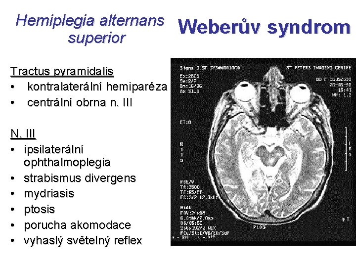 Hemiplegia alternans superior Tractus pyramidalis • kontralaterální hemiparéza • centrální obrna n. III N.