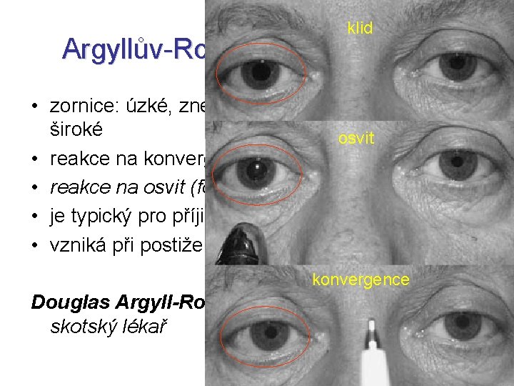 klid Argyllův-Robertsonův syndrom • zornice: úzké, zneokrouhlené, často nestejně široké osvit • reakce na