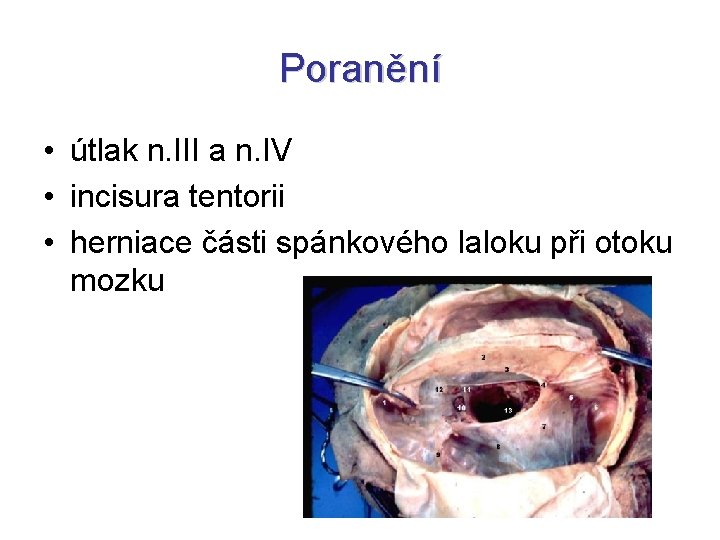 Poranění • útlak n. III a n. IV • incisura tentorii • herniace části