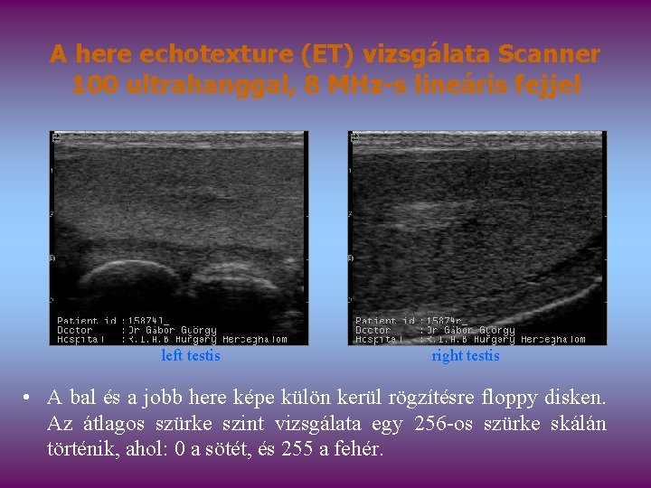 A here echotexture (ET) vizsgálata Scanner 100 ultrahanggal, 8 MHz-s lineáris fejjel left testis