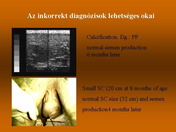 Az inkorrekt diagnózisok lehetséges okai Calcification. Dg. : PP normal semen production 6 months