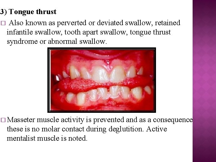 3) Tongue thrust � Also known as perverted or deviated swallow, retained infantile swallow,