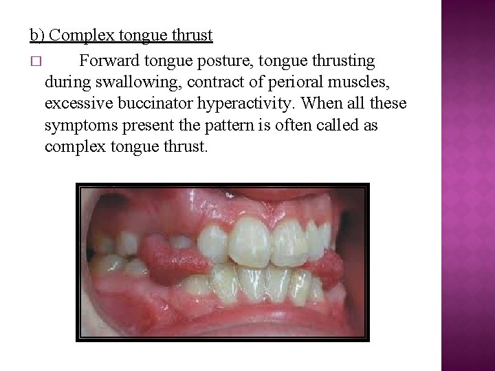 b) Complex tongue thrust � Forward tongue posture, tongue thrusting during swallowing, contract of