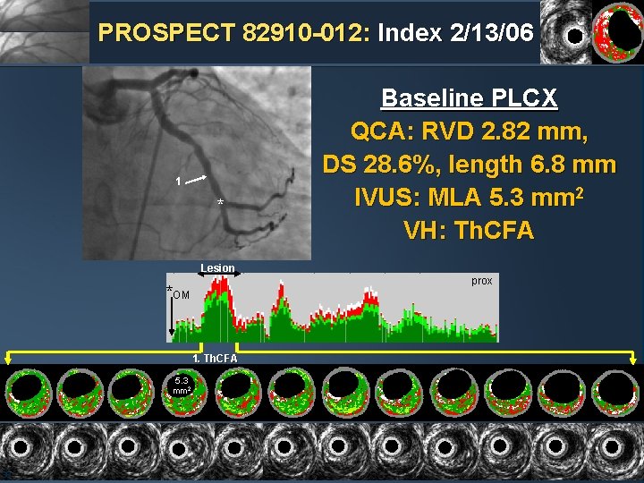 PROSPECT 82910 -012: Index 2/13/06 1 * Baseline PLCX QCA: RVD 2. 82 mm,