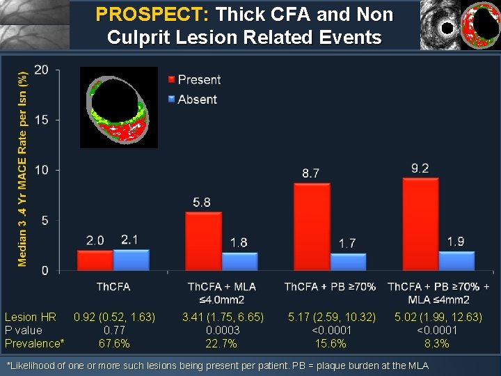 PROSPECT: Thick CFA and Non Culprit Lesion Related Events Lesion HR 0. 92 (0.