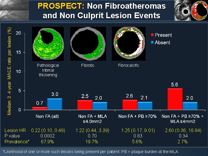 PROSPECT: Non Fibroatheromas and Non Culprit Lesion Events Pathological Intimal thickening Lesion HR 0.